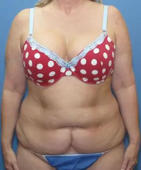 Liposuction - Case 109 - Before