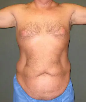 Liposuction - Case 111 - Before