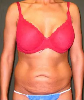 Liposuction - Case 112 - Before