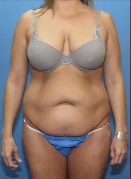 Liposuction - Case 118 - Before