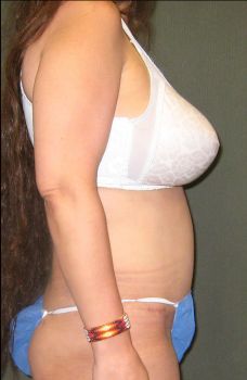 Liposuction Patient Photo - Case 110 - after view-1