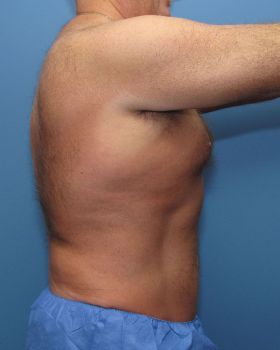 Liposuction Patient Photo - Case 111 - after view-1