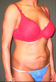 Liposuction Patient Photo - Case 112 - before view-2