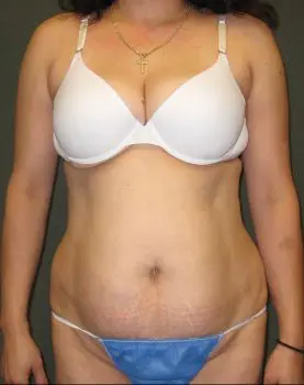 Liposuction - Case 128 - Before