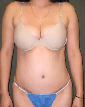 Liposuction - Case 128 - After