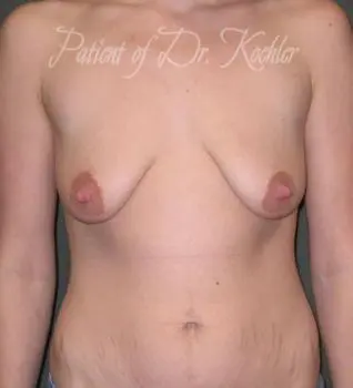 Breast Augmentation/Lift - Case 65 - Before