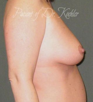 Breast Augmentation/Lift Patient Photo - Case 63 - before view-1