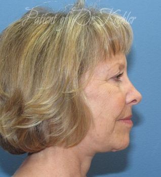 Facelift Patient Photo - Case 78 - after view-1