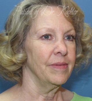 Facelift Patient Photo - Case 78 - before view-2