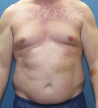 Liposuction - Case 81 - Before