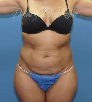 Liposuction - Case 82 - Before