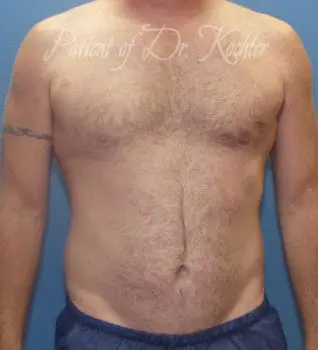 Liposuction - Case 80 - Before