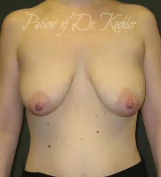 Breast Augmentation/Lift - Case 62 - Before