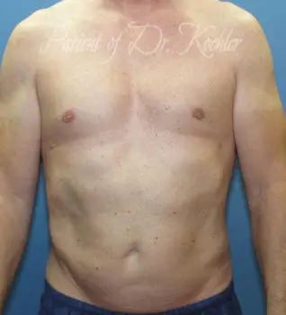 Liposuction - Case 81 - After