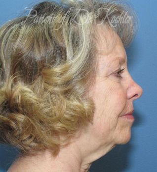 Facelift Patient Photo - Case 78 - before view-1