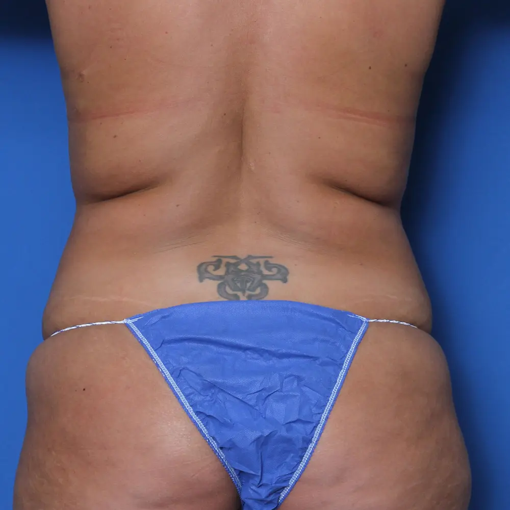 Liposuction - Case 155 - Before