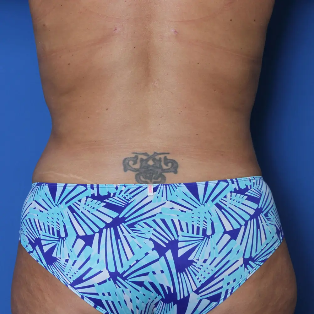 Liposuction - Case 155 - After