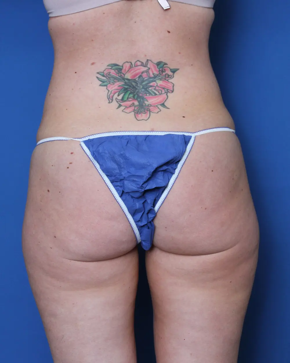 Liposuction - Case 156 - Before