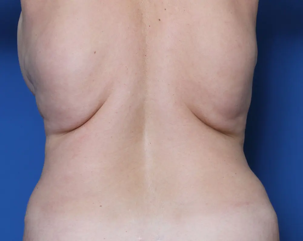 Liposuction - Case 160 - Before