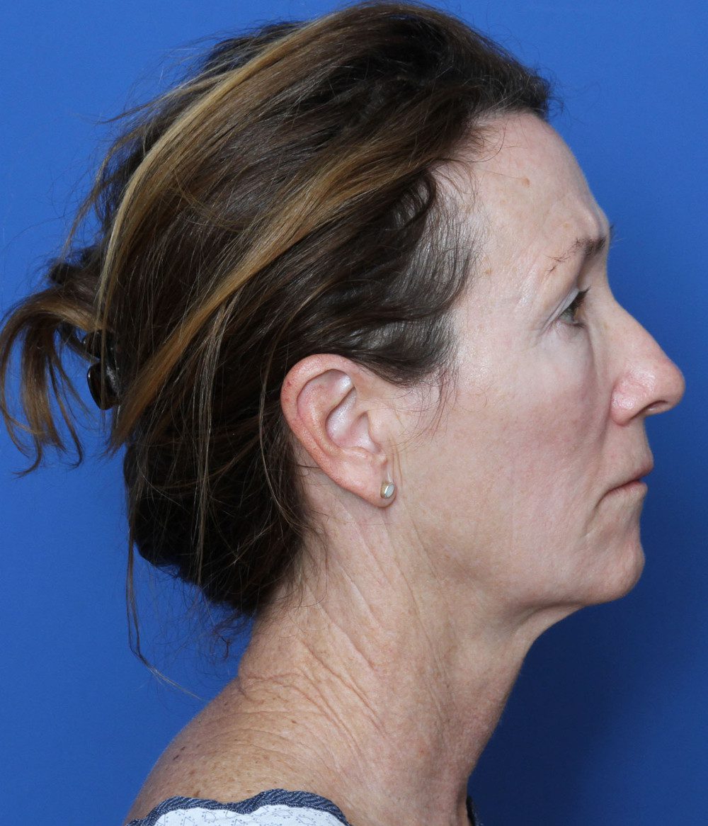 Facelift Patient Photo - Case 168 - before view-2