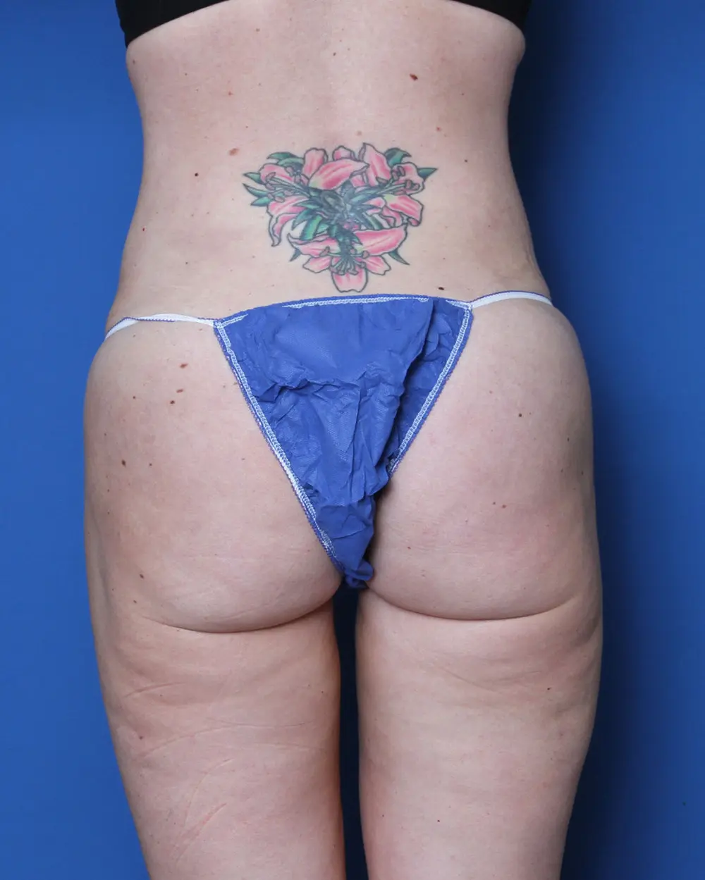 Liposuction - Case 156 - After