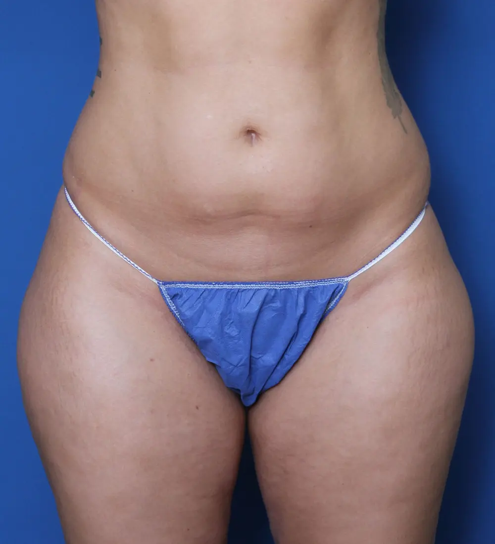 Liposuction - Case 158 - Before