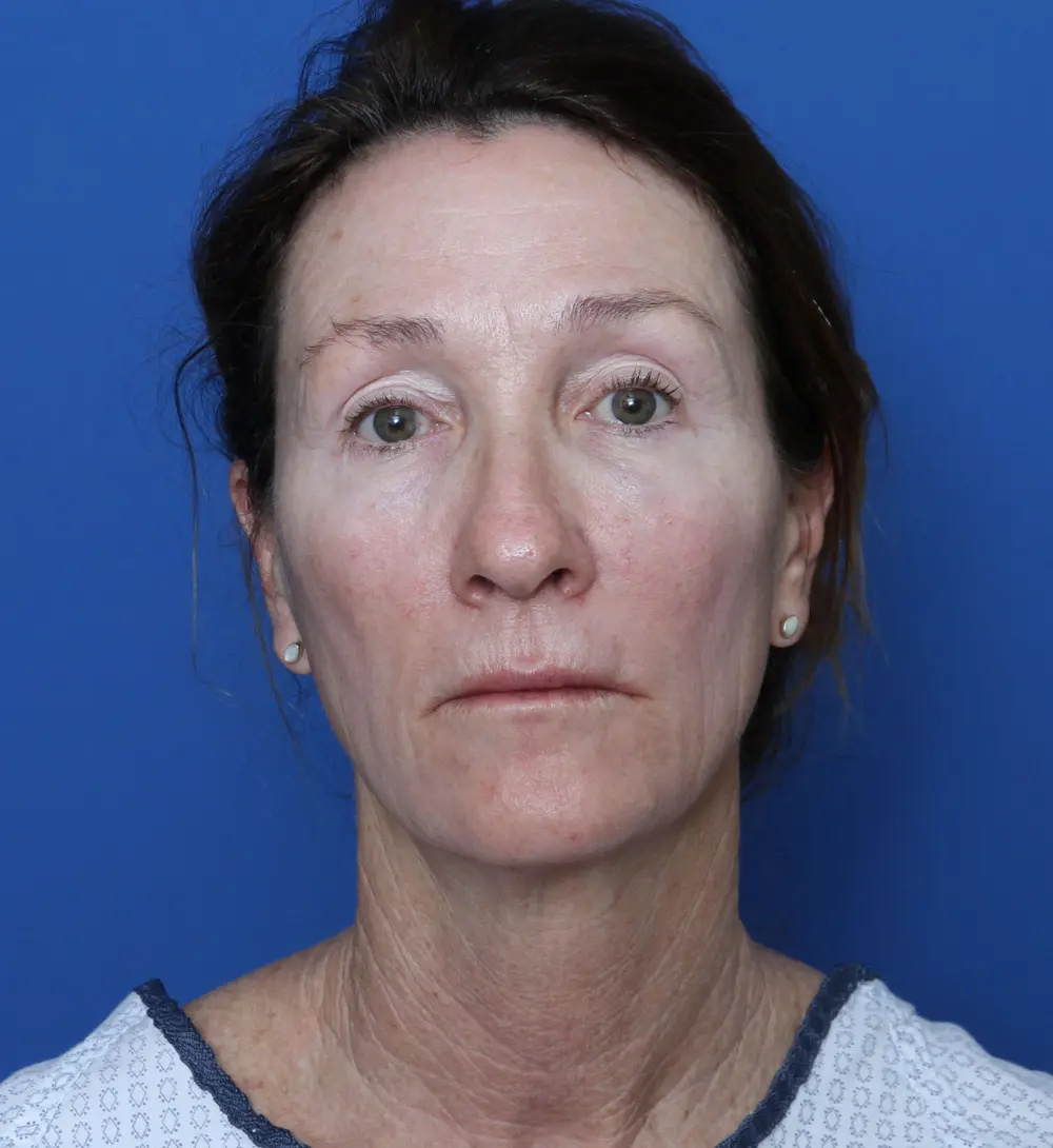 Facelift - Case 168 - Before