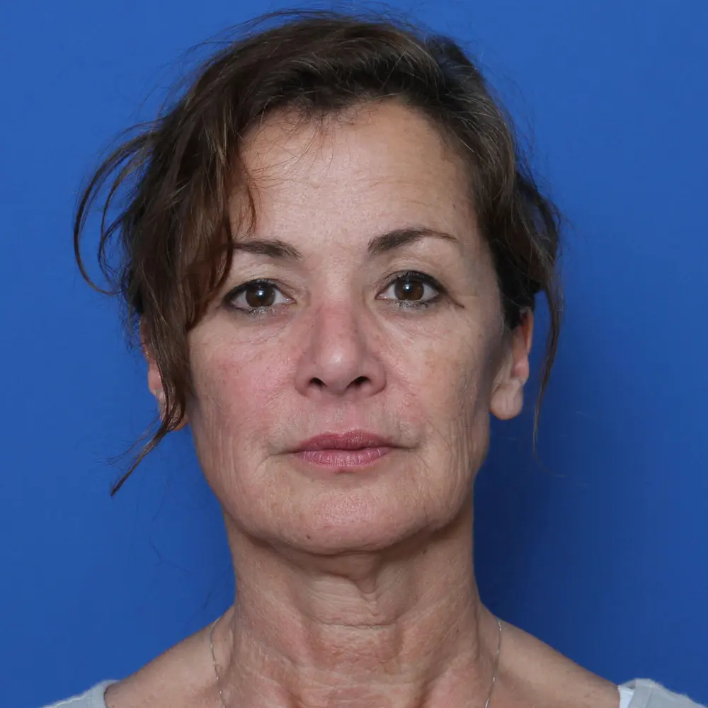 Facelift - Case 169 - Before