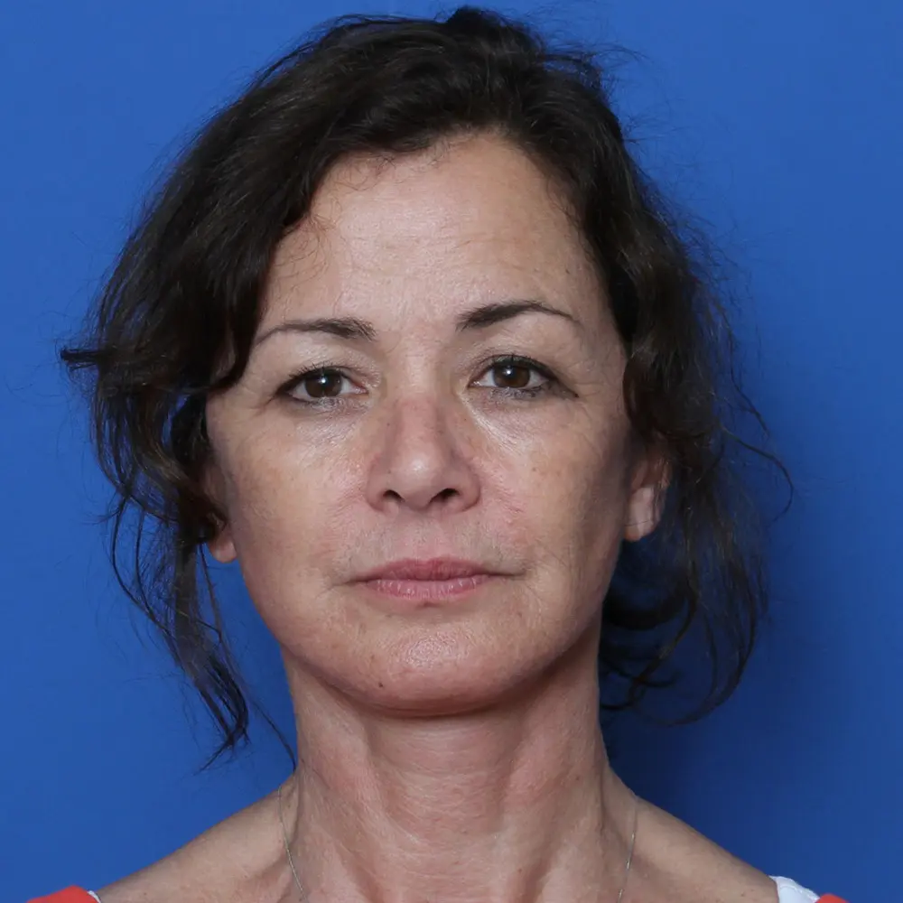 Facelift - Case 169 - After