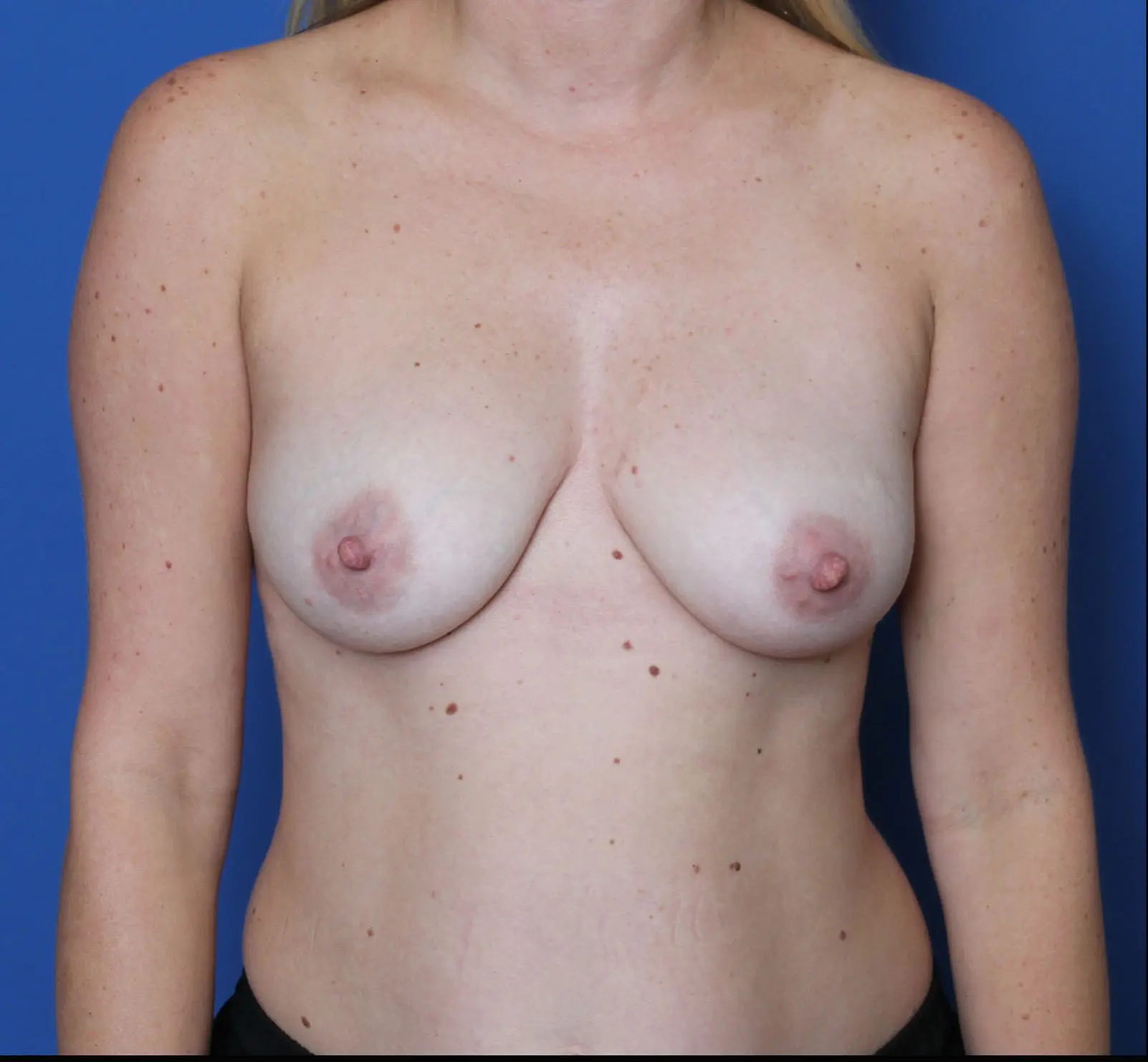 Breast Augmentation/Lift - Case MM9915 - Before