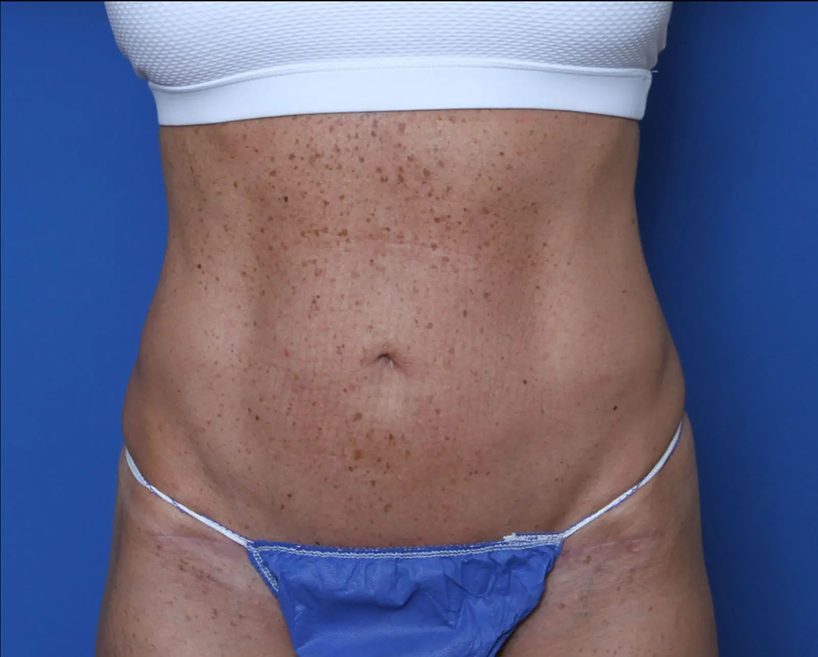 Liposuction - Case 7383 - After