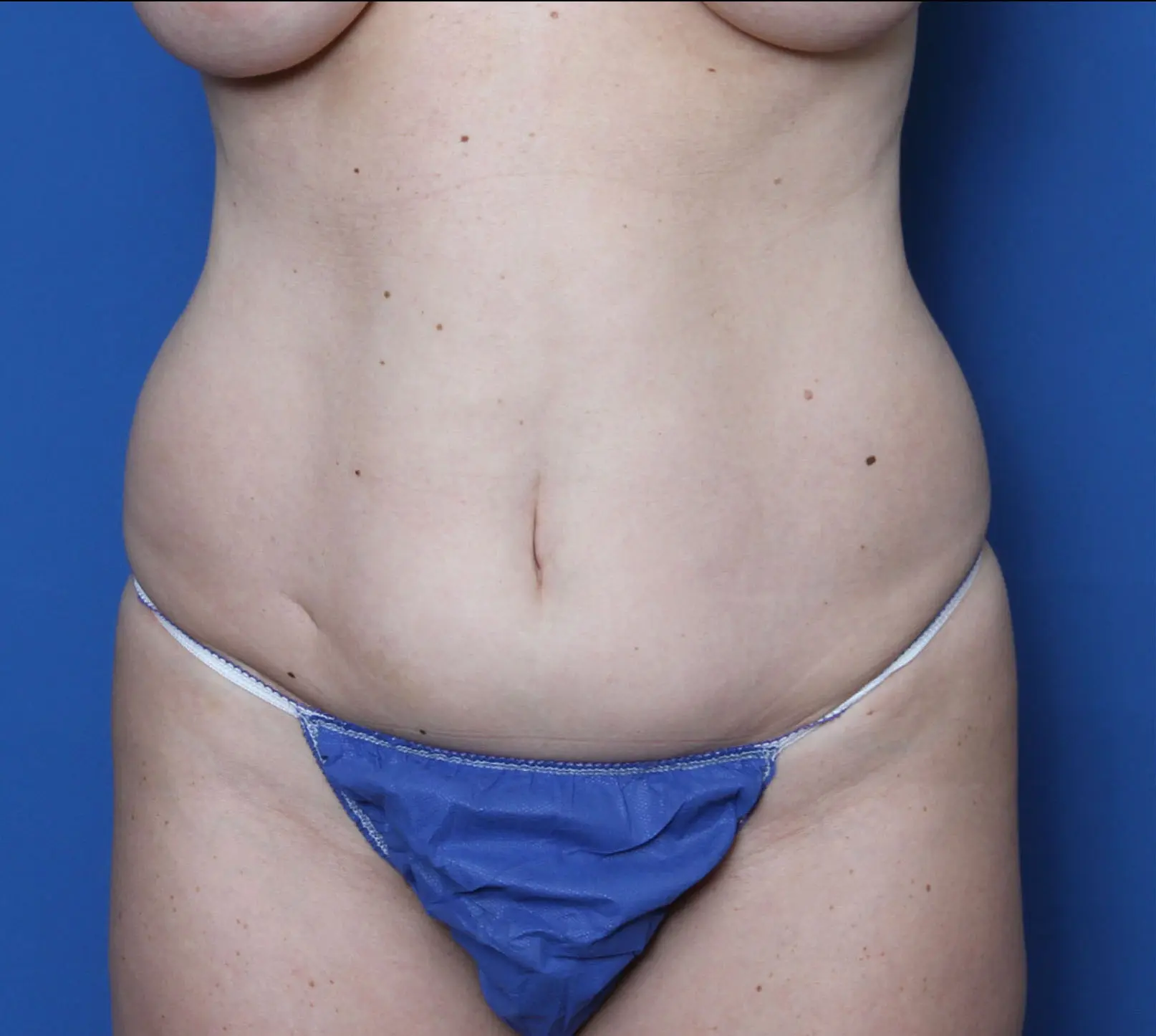 Liposuction - Case 3394 - Before