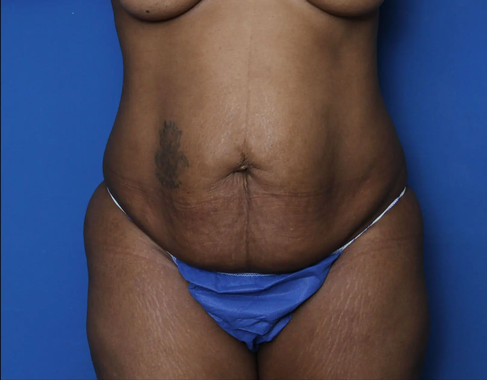 Liposuction - Case 7232 - Before