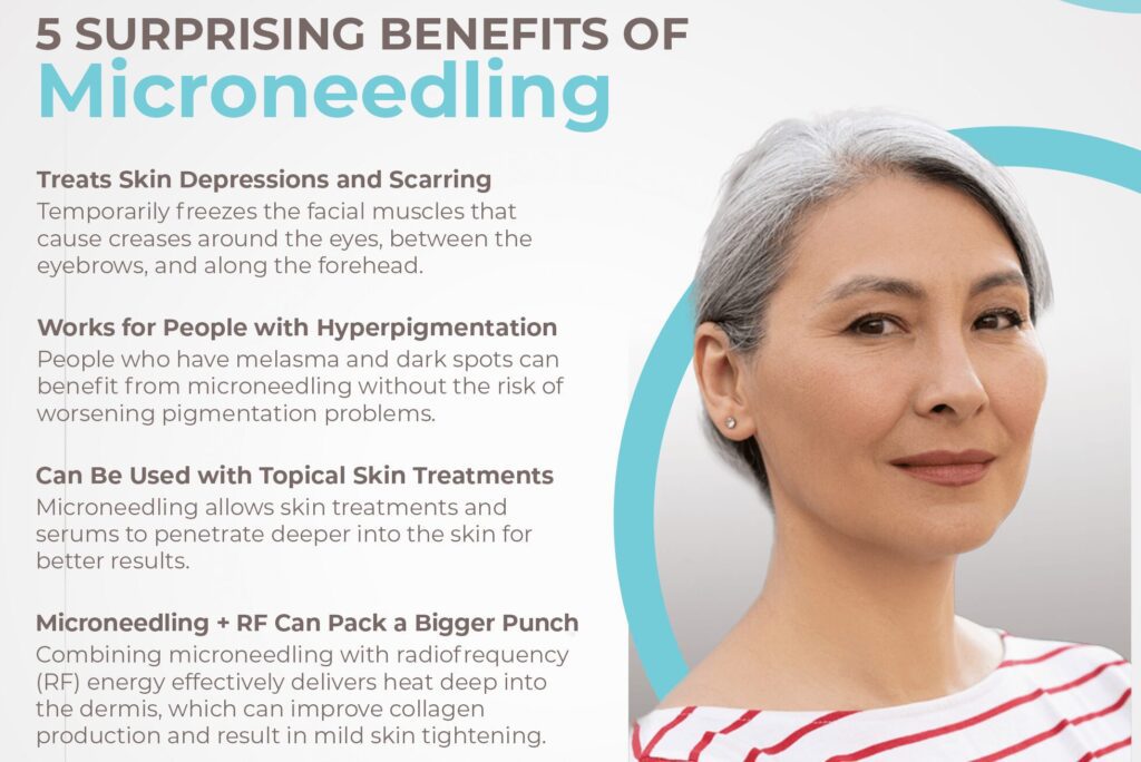 5 Surprising Benefits of Microneedling