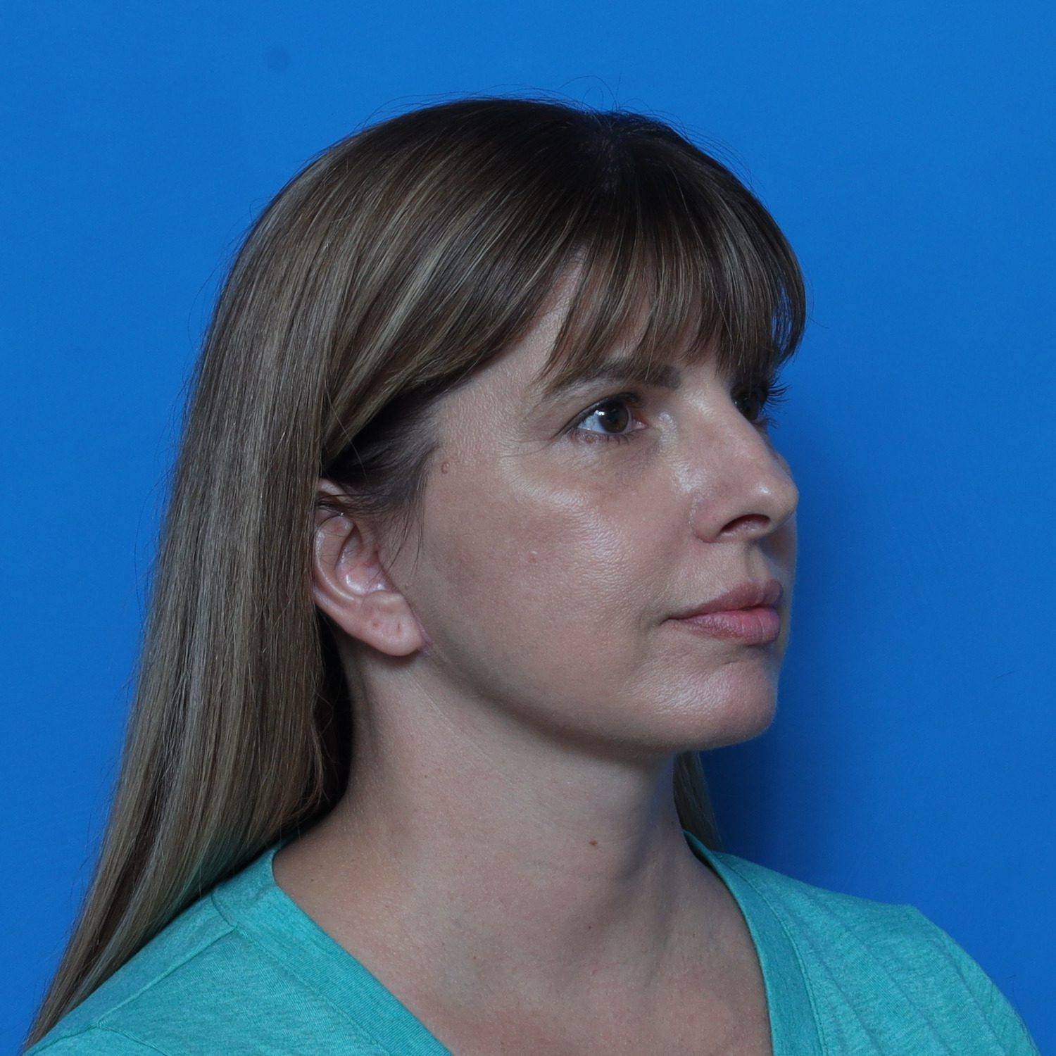 Facelift Patient Photo - Case 10768 - after view-2