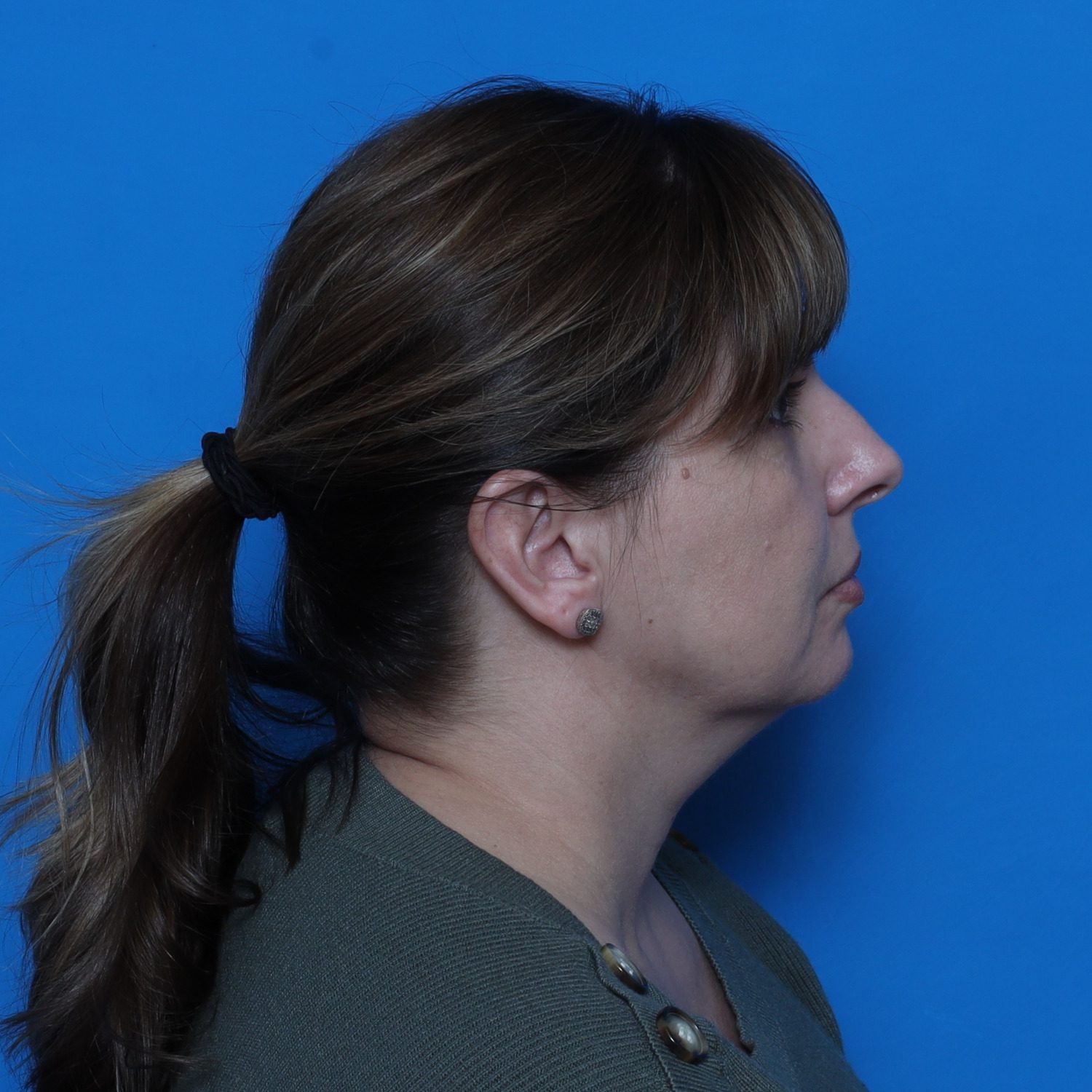 Facelift Patient Photo - Case 10768 - before view-3