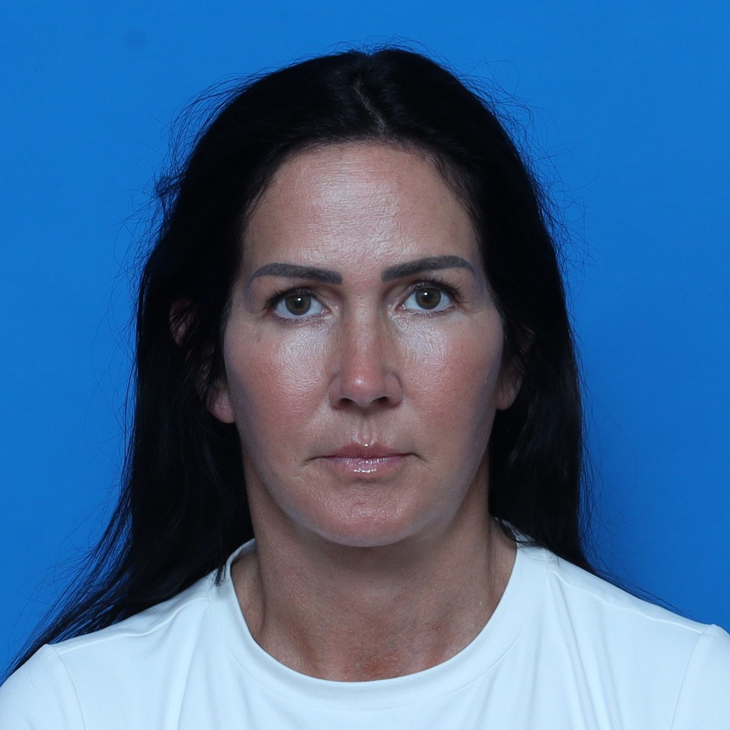 Facelift - Case 10816 - After