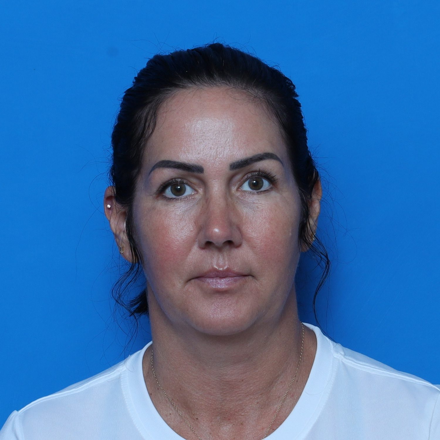 Facelift - Case 10816 - Before