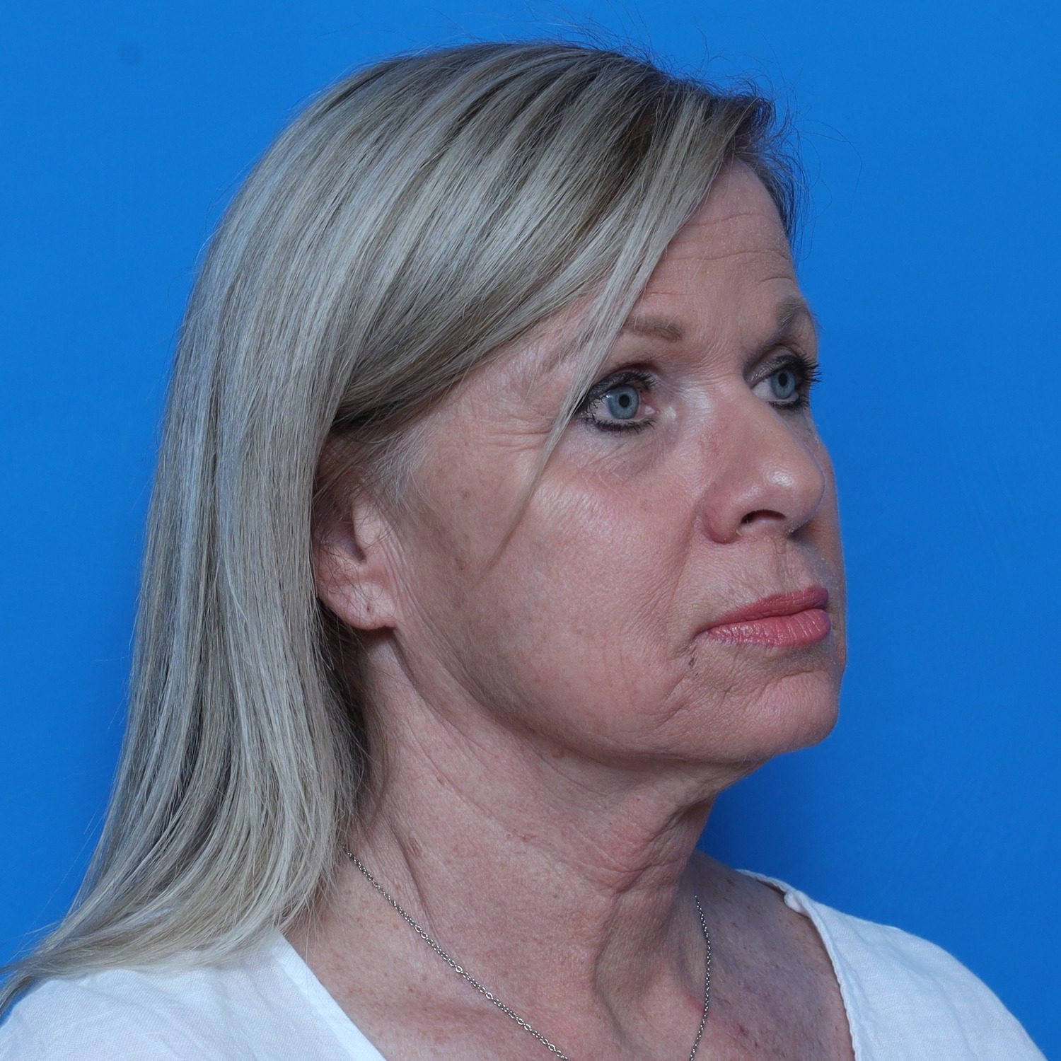 Facelift Patient Photo - Case 10826 - before view-2