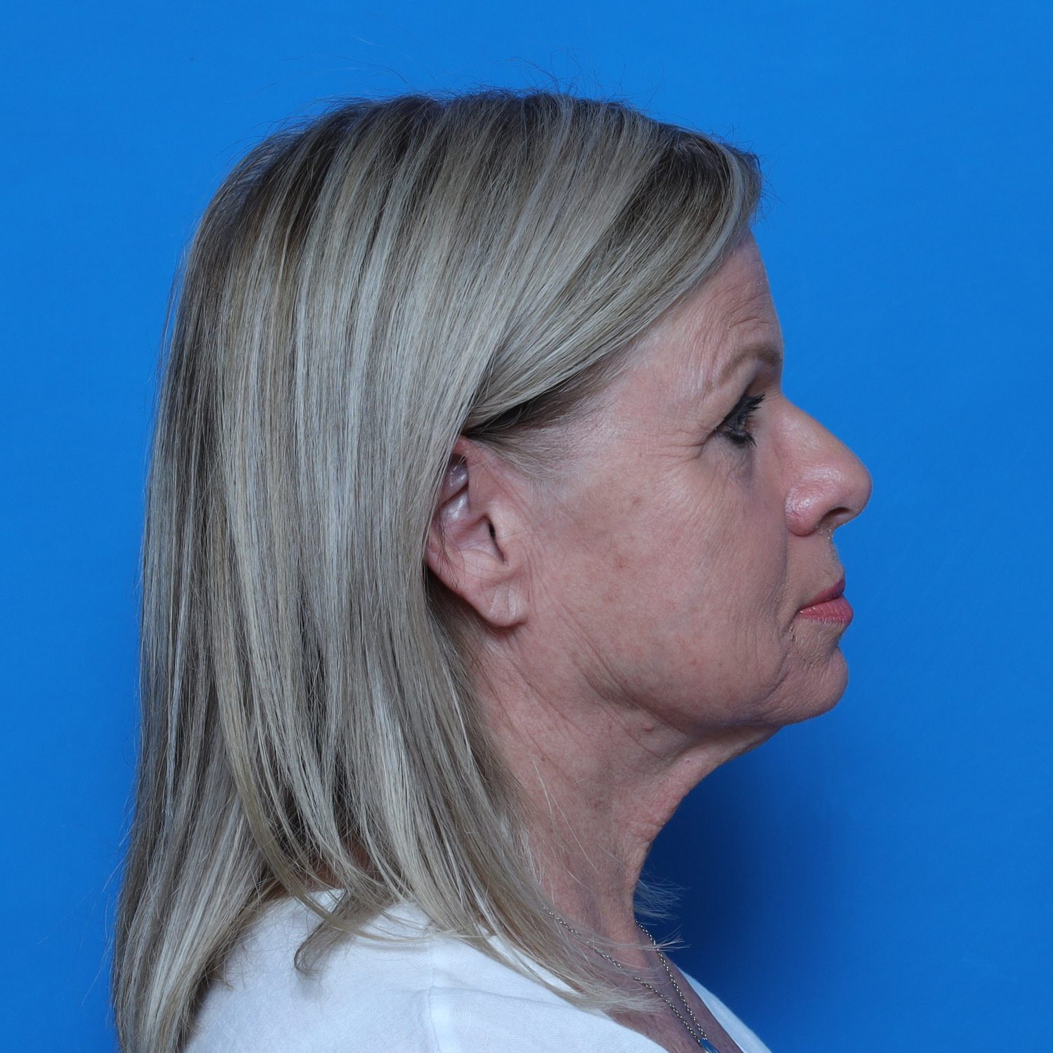 Facelift Patient Photo - Case 10826 - before view-3