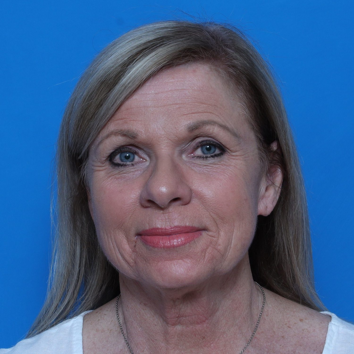 Facelift Patient Photo - Case 10826 - before view-1