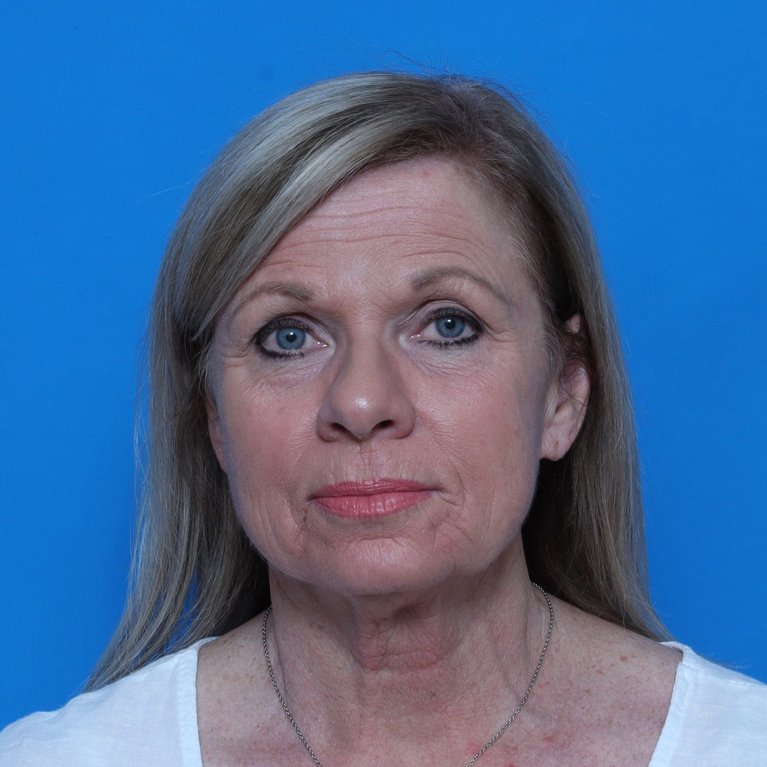 Facelift - Case 10826 - Before