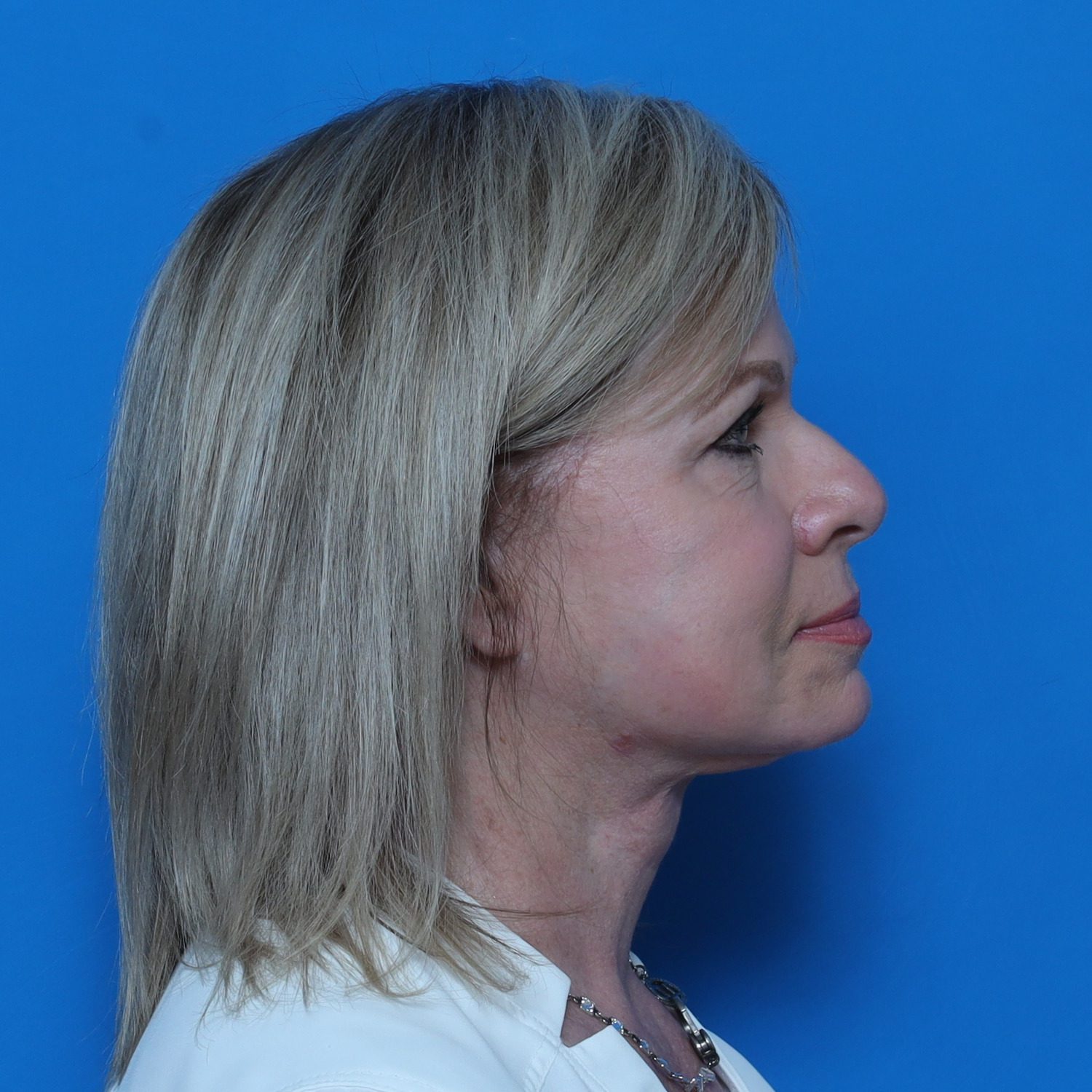 Facelift Patient Photo - Case 10826 - after view-3